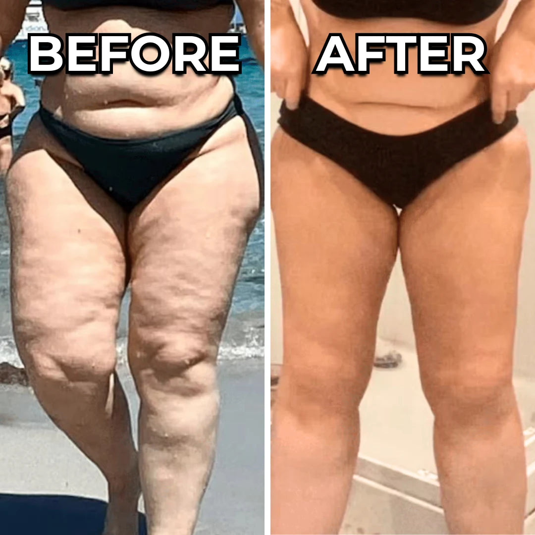 Swellfree™ Lipedema Leggings